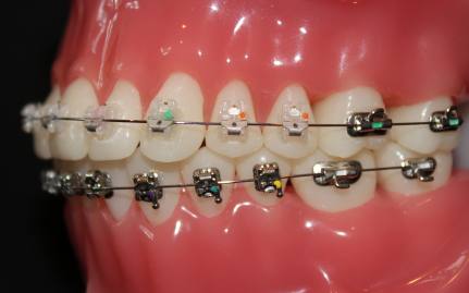 braces model example