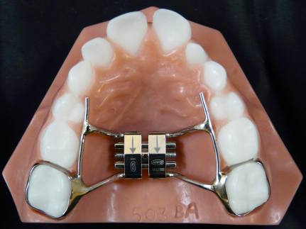 Palatal-Expander-1